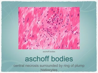 aschoff bodies
central necrosis surrounded by ring of plump
histiocytes
aschoff bodies
 