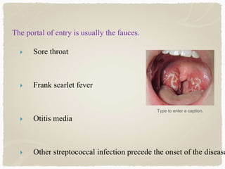 The portal of entry is usually the fauces.
 Sore throat
 Frank scarlet fever
 Otitis media
 Other streptococcal infection precede the onset of the disease
Type to enter a caption.
 