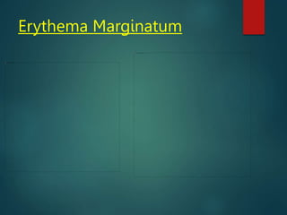 Erythema Marginatum
 