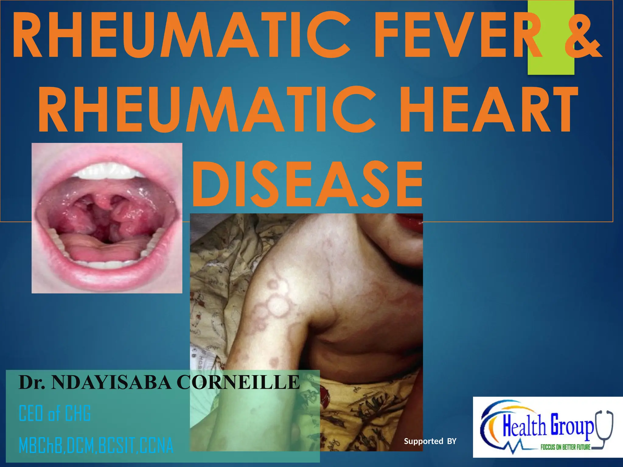 Children With Rhd Subcutaneous Nodules In Rhd