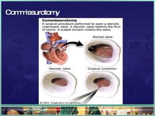 Commissurotomy 