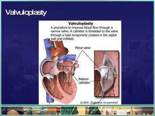 Valvuloplasty 