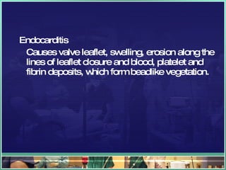 Endocarditis Causes valve leaflet, swelling, erosion along the lines of leaflet closure and blood, platelet and fibrin deposits, which form beadlike vegetation. 