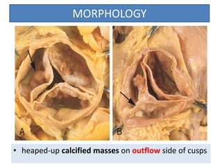 MORPHOLOGY

• heaped-up calcified masses on outflow side of cusps

 