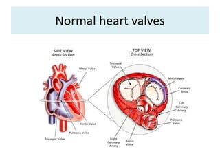 Normal heart valves

 