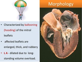 Morphology

• Characterized by ballooning
(hooding) of the mitral
leaflets
• affected leaflets are

enlarged, thick, and rubbery
• L A - dilated due to longstanding volume overload.

 