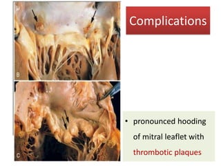 Complications

• pronounced hooding
of mitral leaflet with

thrombotic plaques

 