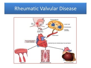 Rheumatic Valvular Disease

 
