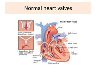 Normal heart valves

 