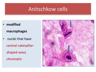 Anitschkow cells
• modified
macrophages
• nuclei that have

central caterpillarshaped wavy
chromatin

 