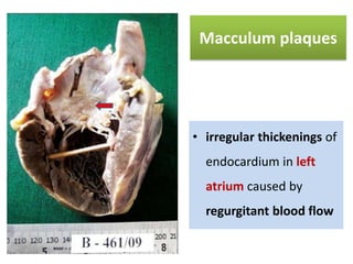 Macculum plaques

• irregular thickenings of
endocardium in left
atrium caused by

regurgitant blood flow

 