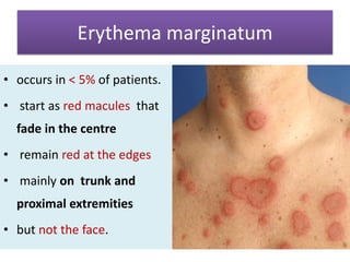 Erythema marginatum
• occurs in < 5% of patients.
• start as red macules that
fade in the centre

• remain red at the edges
• mainly on trunk and

proximal extremities
• but not the face.

 