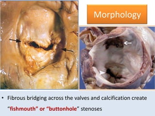 Morphology

• Fibrous bridging across the valves and calcification create
“fishmouth” or “buttonhole” stenoses

 
