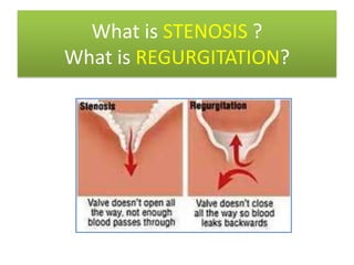 What is STENOSIS ?
What is REGURGITATION?

 