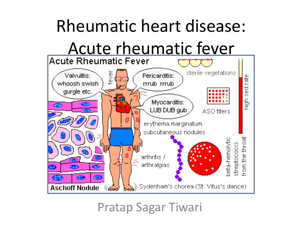 Rheumatic heart disease: Acute Rheumatic Fever