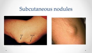 Subcutaneous nodules
 