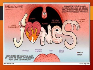 Minor manifestations
• Fever
• Arthralgia
• Previous rheumatic fever
• Raised ESR or CRP
• Leucocytosis
• First-degree AV block
PLUS Supporting evidence of preceding streptococcal
infection: recent scarlet fever, raised antistreptolysin
0 or other streptococcal antibody titre, positive
throat culture
 
