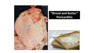 Rheumatic Heart Disease | PPTX