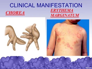 CLINICAL MANIFESTATION
CHOREA
ERYTHEMA
MARGINATUM
 