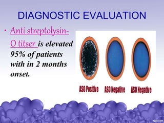 DIAGNOSTIC EVALUATION
• Anti streptolysin-
O titser is elevated
95% of patients
with in 2 months
onset.
 