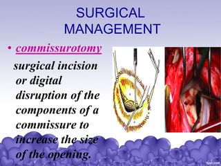 SURGICAL
MANAGEMENT
• commissurotomy
surgical incision
or digital
disruption of the
components of a
commissure to
increase the size
of the opening.
 