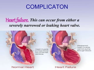COMPLICATON
Heart failure. This can occur from either a
severely narrowed or leaking heart valve.
 