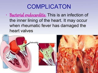 COMPLICATON
• Bacterial endocarditis. This is an infection of
the inner lining of the heart. It may occur
when rheumatic fever has damaged the
heart valves
 