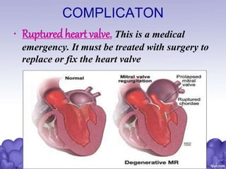 COMPLICATON
• Ruptured heart valve. This is a medical
emergency. It must be treated with surgery to
replace or fix the heart valve
 