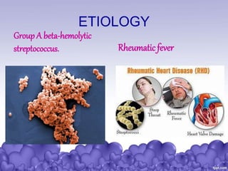 ETIOLOGY
Group A beta-hemolytic
streptococcus. Rheumatic fever
 