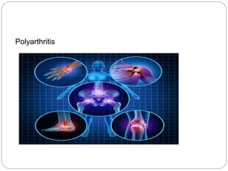 Polyarthritis
 