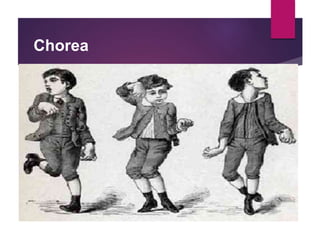 Chorea
 