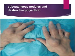 subcutaneous nodules and
destructive polyarthriti
 