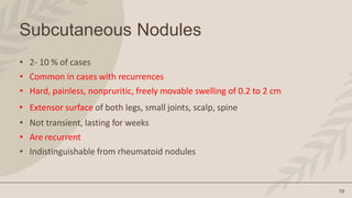 19
Subcutaneous Nodules
• 2- 10 % of cases
• Common in cases with recurrences
• Hard, painless, nonpruritic, freely movable swelling of 0.2 to 2 cm
• Extensor surface of both legs, small joints, scalp, spine
• Not transient, lasting for weeks
• Are recurrent
• Indistinguishable from rheumatoid nodules
 