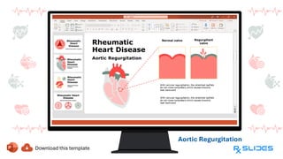 Rheumatic Heart Disease ( RHD ) | PDF