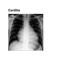 Rheumatic heart disease conditions and its care | PDF