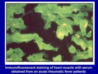 Immunofluorescent staining of heart muscle with serum
obtained from an acute rheumatic fever patients
 