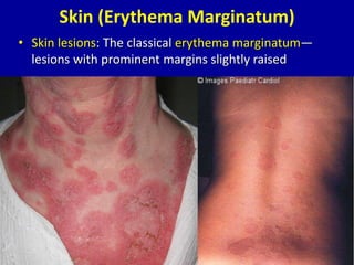 Skin (Erythema Marginatum)
• Skin lesions: The classical erythema marginatum—
lesions with prominent margins slightly raised
 