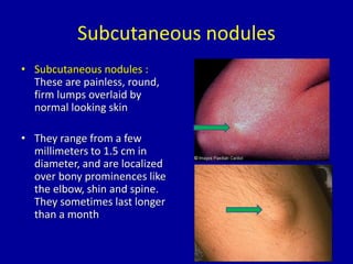 Subcutaneous nodules
• Subcutaneous nodules :
These are painless, round,
firm lumps overlaid by
normal looking skin
• They range from a few
millimeters to 1.5 cm in
diameter, and are localized
over bony prominences like
the elbow, shin and spine.
They sometimes last longer
than a month
 