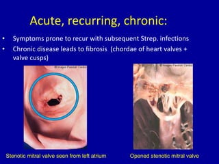 Acute, recurring, chronic:
• Symptoms prone to recur with subsequent Strep. infections
• Chronic disease leads to fibrosis (chordae of heart valves +
valve cusps)
Stenotic mitral valve seen from left atrium Opened stenotic mitral valve
 