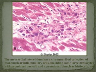 The myocardial interstitium has a circumscribed collection of
mononuclear inflammatory cells, including some large histiocytes
with prominent nucleoli and a prominent binuclear histiocyte, and
central necrosis
 