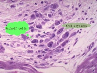Owl 's eye cells
Aschoff cells
 