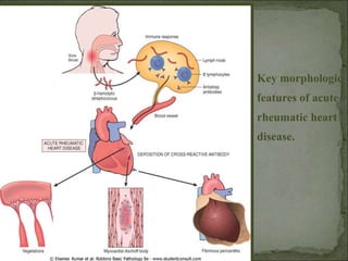 Key morphologic
features of acute
rheumatic heart
disease.
 