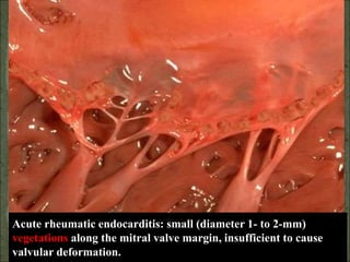 Acute rheumatic endocarditis: small (diameter 1- to 2-mm)
vegetations along the mitral valve margin, insufficient to cause
valvular deformation.
 