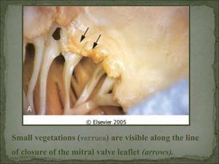Small vegetations (verruca) are visible along the line
of closure of the mitral valve leaflet (arrows).
 