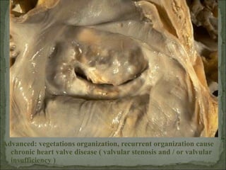 Advanced: vegetations organization, recurrent organization cause
chronic heart valve disease ( valvular stenosis and / or valvular
insufficiency )
 