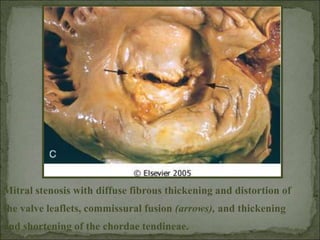 Mitral stenosis with diffuse fibrous thickening and distortion of
the valve leaflets, commissural fusion (arrows), and thickening
and shortening of the chordae tendineae.
 