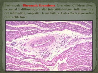 Perivascular Rheumatic Granuloma formation. Children often
occurred to diffuse myocardial interstitial edema, inflammatory
cell infiltration, congestive heart failure. Late effects myocardial
contractile force.
 