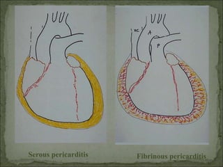 Serous pericarditis Fibrinous pericarditis
 