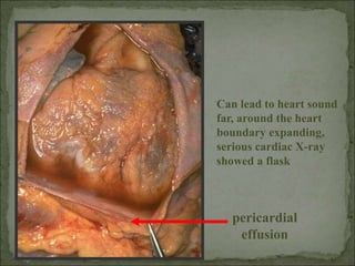 pericardial
effusion
Can lead to heart sound
far, around the heart
boundary expanding,
serious cardiac X-ray
showed a flask
 