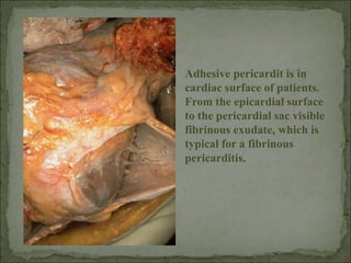 Adhesive pericardit is in
cardiac surface of patients.
From the epicardial surface
to the pericardial sac visible
fibrinous exudate, which is
typical for a fibrinous
pericarditis.
 